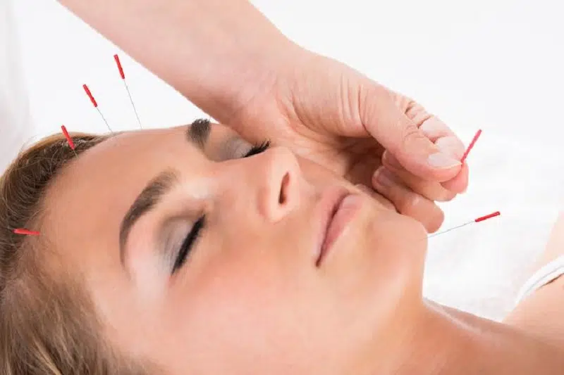 Les bienfaits de l'acupuncture